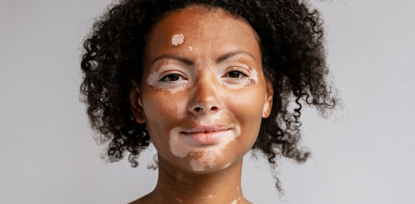 Vitiligo-dermatološki poremećaj pigmentacije