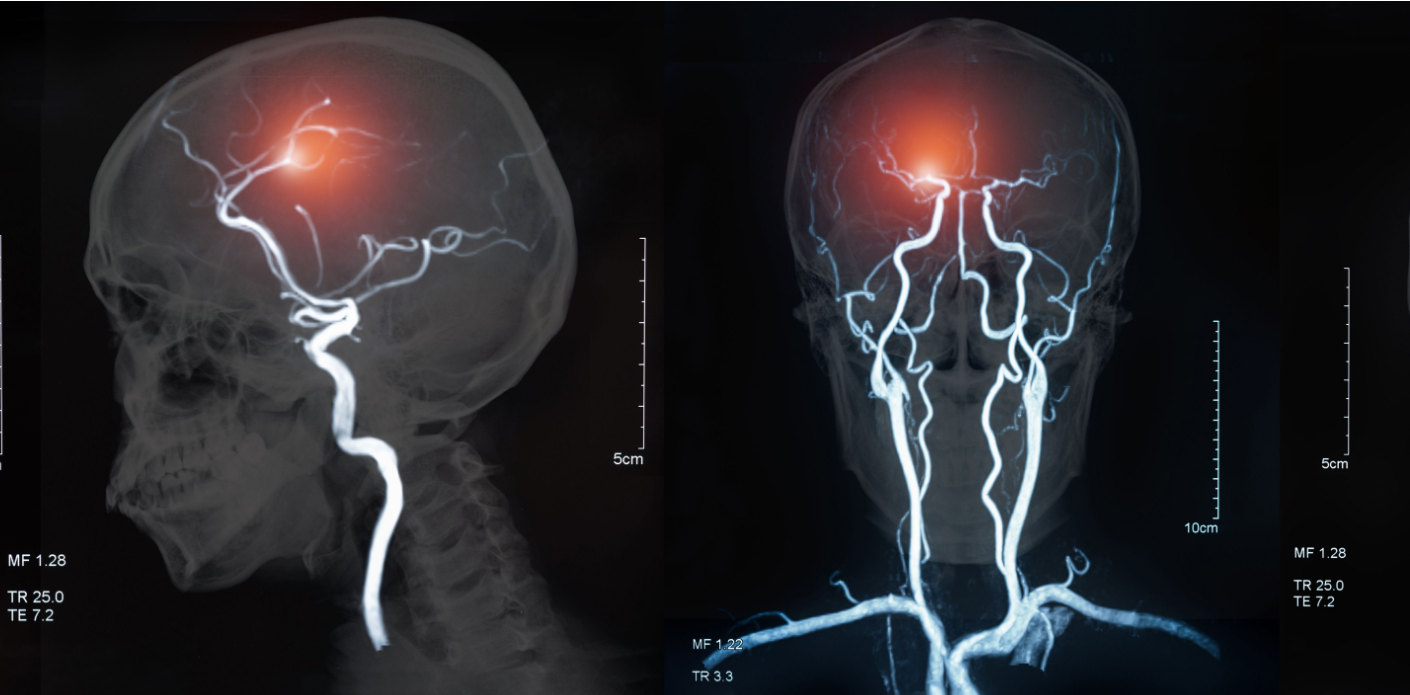 Migrena- više od glavobolje